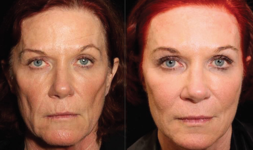 non surgical facelift before after mississauga oakville toronto